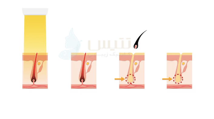 مکانیسم حذف موهای زائد توسط لیزر