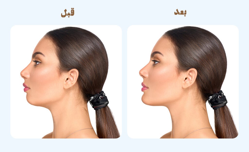 نمونه تزریق فیلر چانه