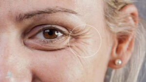 روش های از بین بردن خطوط پنجه کلاغی صورت