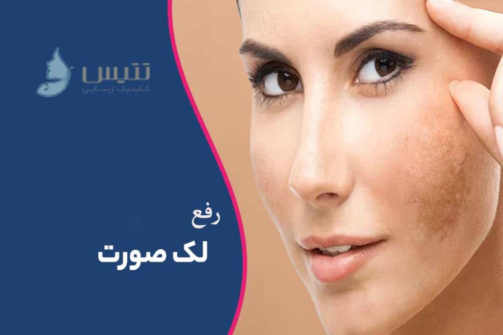 لیزر هلیوس برای لک خوبه؟