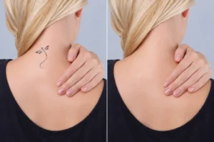 چند جلسه برای پاک کردن کامل تاتو لازم است؟